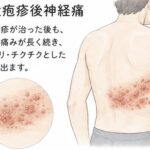 【名古屋市瑞穂区の鍼灸】頭がピリピリ痛い！左前頭部 帯状疱疹後神経痛 改善事例|中澤治療院｜